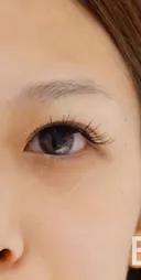 二重全切開で平行二重 before画像 サムネイル用