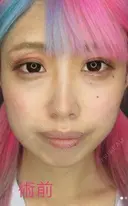 バッカルファット+ツヤ肌コラーゲンリフト before画像 サムネイル用