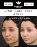人中短縮・小鼻縮小・鼻翼挙上・鼻孔縁挙上 before画像 サムネイル用