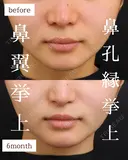 人中短縮・小鼻縮小・鼻翼挙上・鼻孔縁挙上 180日後 サムネイル用