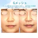 【30代女性・自然に鼻筋を整える】G-Mesh（Gメッシュ）による鼻形成（直後） 0日後 サムネイル用