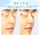 【30代女性・自然に鼻筋を整える】G-Mesh（Gメッシュ）による鼻形成（直後） 0日後 サムネイル用