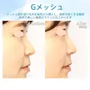 【30代女性・自然に鼻筋を整える】G-Mesh（Gメッシュ）による鼻形成（直後） 0日後 サムネイル用