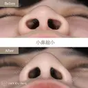 小鼻縮小（内側法・外側法） before画像 サムネイル用