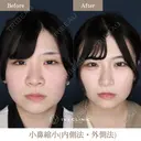 小鼻縮小（内側法・外側法） after画像 サムネイル用