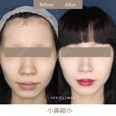 小鼻縮小 after画像 サムネイル用