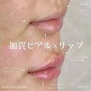 加賀ヒアル×リップ after画像 サムネイル用