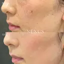 ピコスポット（シミ治療） after画像 サムネイル用
