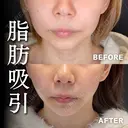 輪郭のもたつき解消😄顔の脂肪吸引 90日後 サムネイル用