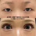 全切開＋眼瞼下垂修正＋ROOF切除 30日後 サムネイル用