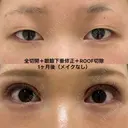 全切開＋眼瞼下垂修正＋ROOF切除 30日後 サムネイル用