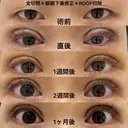 全切開＋眼瞼下垂修正＋ROOF切除 30日後 サムネイル用