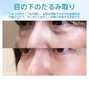 【40代女性・目の下のクマ・シワ・タルミ・膨らみ・凹みをスッキリ】ハムラ法（術後1ヶ月） after画像 サムネイル用