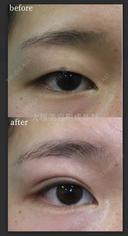 埋没法でくっきり二重に🥰 before画像 サムネイル用