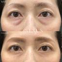 裏ハムラ法＋脂肪注入 after画像 サムネイル用
