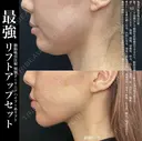 脂肪吸引注射+リニアハイフ+糸リフト before画像 サムネイル用