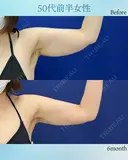 VASER脂肪吸引 二の腕、肩、肩甲骨横 before画像 サムネイル用