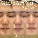 当院人気No1🌟ホクロ・イボ３個18,000円 after画像 サムネイル用