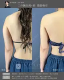 張り出し部分もまっすぐ綺麗に✨二の腕・肩脂肪吸引 before画像 サムネイル用