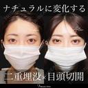 二重埋没・目頭切開 before画像 サムネイル用