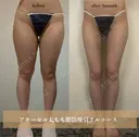アキーセル太腿脂肪吸引 before画像 サムネイル用