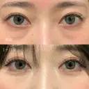 目の下のクマ取り before画像 サムネイル用