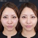 小鼻縮小 30日後 サムネイル用