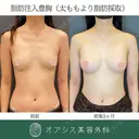 自然な仕上がりでバストアップ✨脂肪注入豊胸 90日後 サムネイル用