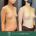 自然な仕上がりでバストアップ✨脂肪注入豊胸 90日後 サムネイル用