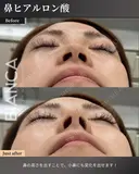 切らずに整える🌹鼻のヒアルロン酸注入💉 after画像 サムネイル用