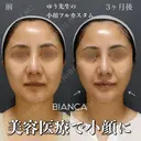 理想の輪郭を手に入れよう💓顔の脂肪吸引＋糸リフト 90日後 サムネイル用