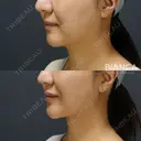 理想の輪郭を手に入れよう💓顔の脂肪吸引＋糸リフト 90日後 サムネイル用