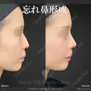 鼻尖形成3D法＋軟骨移植＋わし鼻修正※MD式 30日後 サムネイル用