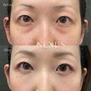 切らない目の下のたるみ取り＋脂肪注入 before画像 サムネイル用