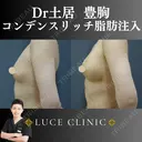 コンデンスリッチ脂肪豊胸 before画像 サムネイル用