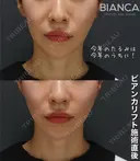 あなたに合ったデザインに😄✨ビアンカ糸リフト before画像 サムネイル用