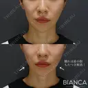 あなたに合ったデザインに😄✨ビアンカ糸リフト after画像 サムネイル用