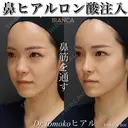 ナチュラルで美しい鼻筋🌷ヒアルロン酸注入💉 after画像 サムネイル用