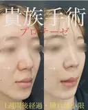 口腔内切開人中短縮×貴族手術×猫手術 after画像 サムネイル用