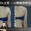 二の腕脂肪吸引 before画像 サムネイル用