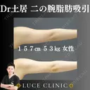 二の腕脂肪吸引 before画像 サムネイル用
