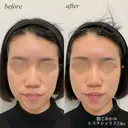額、こめかみヒアルロン酸注入 before画像 サムネイル用