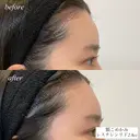 額、こめかみヒアルロン酸注入 after画像 サムネイル用