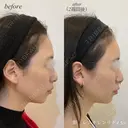 額ヒアルロン酸注入 after画像 サムネイル用