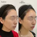額ヒアルロン酸注入 after画像 サムネイル用