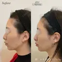 額ヒアルロン酸注入 after画像 サムネイル用