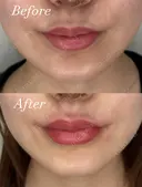 唇ヒアルロン酸 before画像 サムネイル用