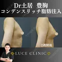 コンデンスリッチ脂肪豊胸 after画像 サムネイル用