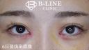 【韓流目頭切開術】手術6日後（抜糸直後） after画像 サムネイル用