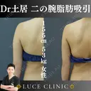 二の腕脂肪吸引 after画像 サムネイル用